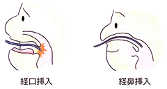 経口挿入図と経鼻挿入図